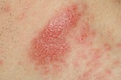 Infected eczema on the neck