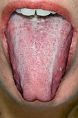 Oral thrush in an alcoholic patient