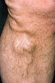 Varicose vein in the leg