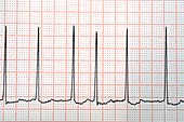 Atrial fibrillation of the heartbeat