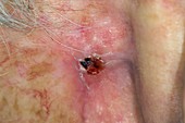 Skin cancer behind the ear