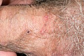 Shingles lesions on the penis