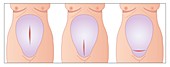 Caesarean section womb incisions,artwork