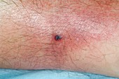 Infected horsefly bite on the leg