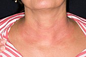 Eczema on the neck