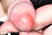Inflamed penis (balanitis)