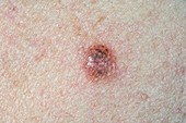 Inflamed compound naevus (mole)