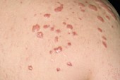 Keloid scars in acne vulgaris