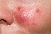 Acne rosacea on the cheek