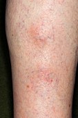 Thrombophlebitis in the leg