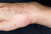 Wrist swelling in polyarthropathy