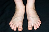 Bilateral flat feet