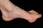 Claw foot (pes cavus)