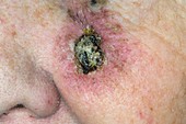 Skin cancer on face after radiotherapy