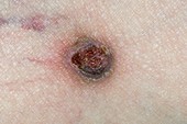 Basal cell skin cancer on the leg