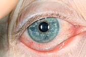 Red eye from viral conjunctivitis