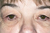Red eyes from bacterial conjunctivitis