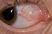 Episcleritis of the eye