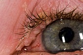 Herpes simplex lesions on eyelid