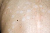 Lighter skin after psoriasis treatment