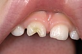 Broken tooth (incisor) after a fall