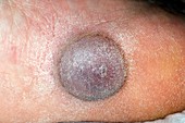 Wart after freezing treatment