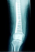 Pinned femur bone of the leg,X-ray