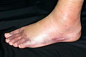 Bruised foot from running