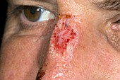 Soft tissue injury to the nose