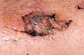 Skin wound healing after car accident