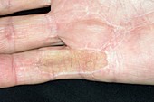 Scar from Dupuytrens contracture surgery