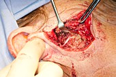 Parotid tumour surgery