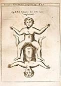 1662 Schott conjoined infants