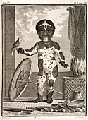 1777 African American Vitiligo Buffon