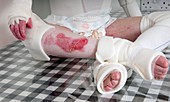 Leg of girl with epidermylosis bullosa