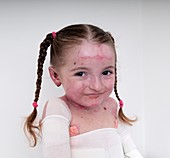 Young girl with epidermylosis bullosa