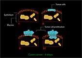 Colon cancer stages,diagram