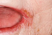 Angular stomatitis of the lips