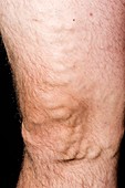 Varicose veins in the leg