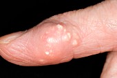 Gout tophus on the finger