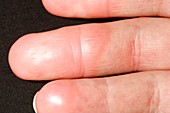 Discoloured fingers in AML leukaemia