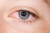 Adenoviral conjunctivitis of the eye