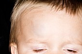 Bump on the forehead in a child