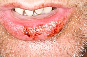 Cold sores on the lower lip