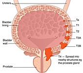 Bladder cancer stages,artwork