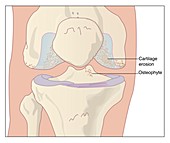 Osteoarthritic knee,artwork