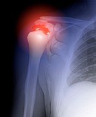 Arthritis of the shoulder,artwork