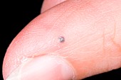 Small haematoma on finger