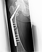 Pinned hip fracture,X-ray