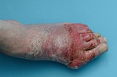Cellulitis of the foot